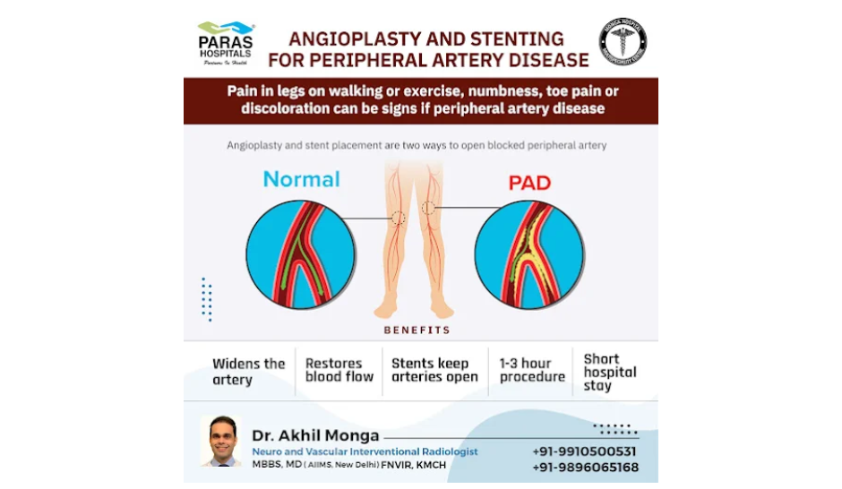 varicose veins tratment
